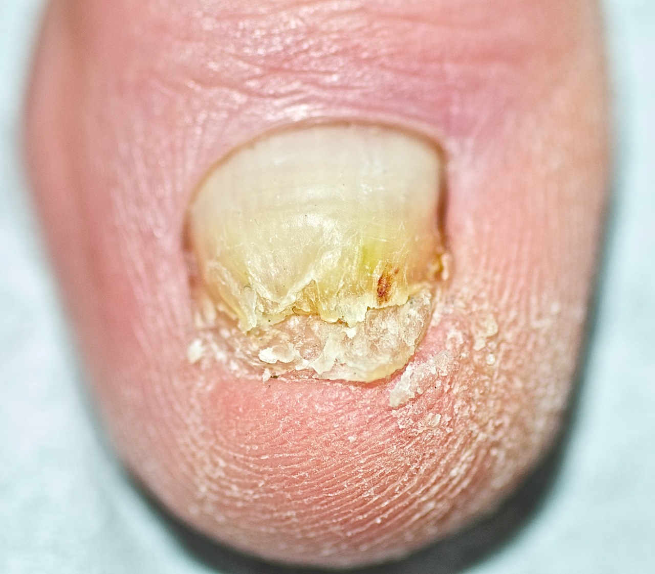Hongos en las uñas.  Clínica Dr. Santiago Santamaría